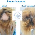 Aalopecia areata